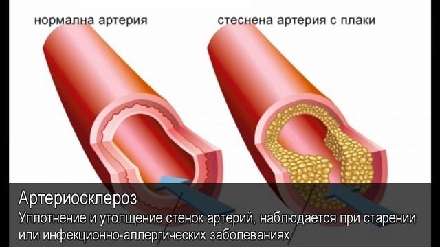 Артериосклероз. Толковый Видеословарь русского языка смотреть онлайн
