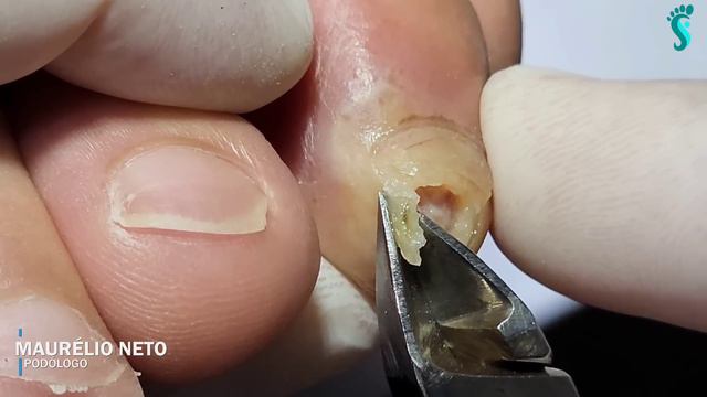 O QUE PODE TER ACONTECIDO ? #podologomaurelio #ingrowntoenail #nails #like @podologo.maurelio смотреть онлайн