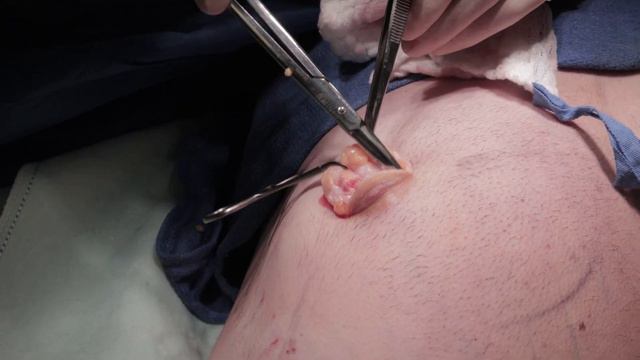 GYNCOMASTIA SURGERY & BEYOND NEW YORK MALE 23: UNI-LATERAL GLAND REMOVAL MONSTER GLAND