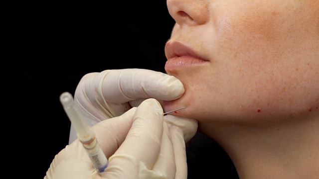 Unterspritzungstechnik JAWLINE und JOCHBEIN FILLER – TFA by doc.rolf смотреть онлайн
