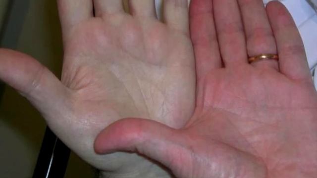 Почему руки холодные? Холодные ноги: причины и лечение. Ледяные руки и ноги. Полезные советы из ССС смотреть онлайн