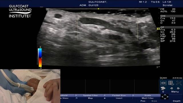 Hot Tips - Testicular Ultrasound for Varicocele смотреть онлайн