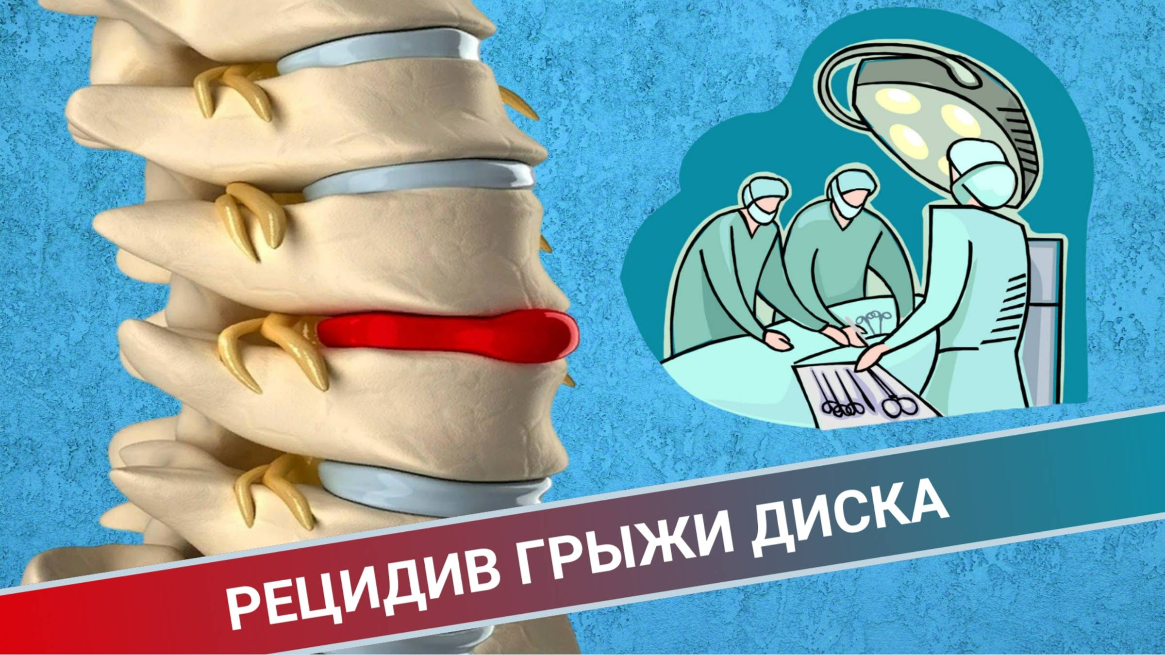 РЕЦИДИВ ГРЫЖИ ДИСКА || НУЖНО ЛИ ДЕЛАТЬ ОПЕРАЦИЮ ПОВТОРНО? смотреть онлайн