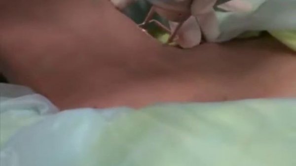 Лазер DeepRENU CO2 Sybaritic