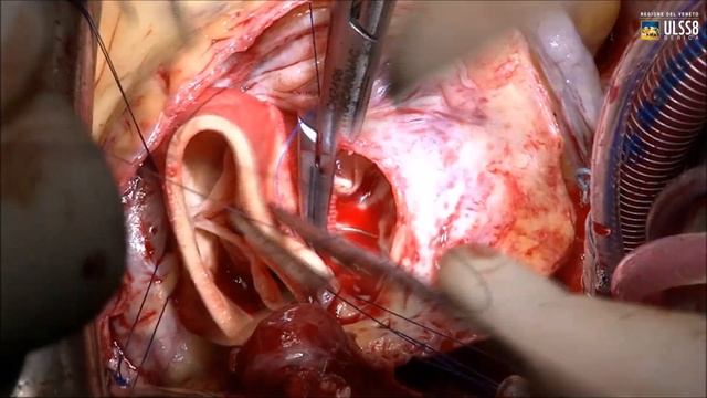 Aneurisma gigante de Aorta ascendente смотреть онлайн