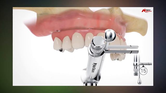Full Arch Dental Implant - Peachtree City, GA - Dr. Paul Anderson смотреть онлайн