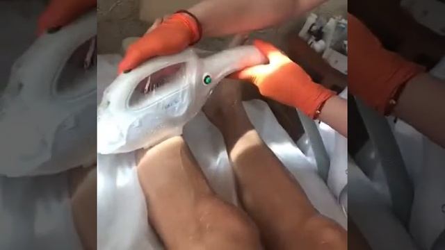 Фотоэпиляция голени , Ставрополь