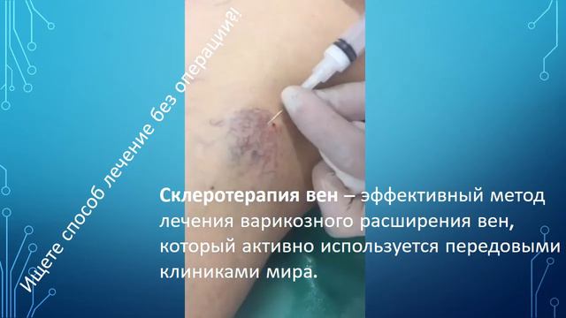 Склеротерапия вен нижних конечностей. смотреть онлайн
