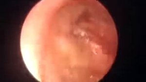 Сигмовидная кишка  Нормальная и пораженная раком