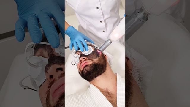 КАРБОНОВЫЙ ПИЛИНГ Сеть клиник косметологии GEN87 смотреть онлайн