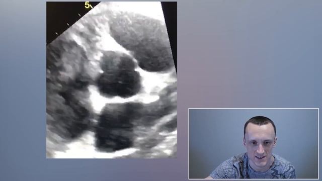 Тромб в сердце. Тромб в предсердии.