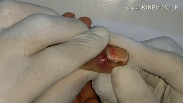 Paronychia - Inflammation Of Nail Fold