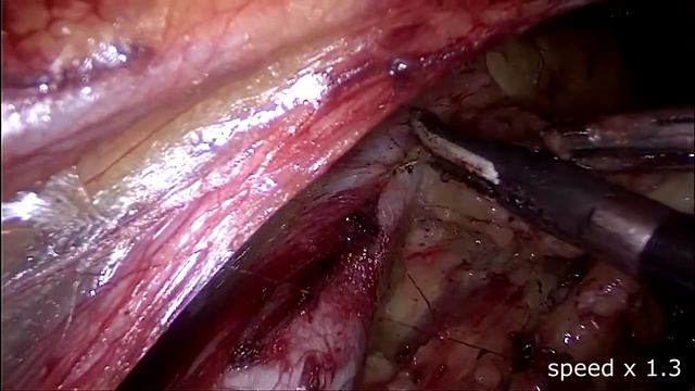 Парааортальная лимфодиссекция (left aortal) ретроперитонеальным доступом смотреть онлайн