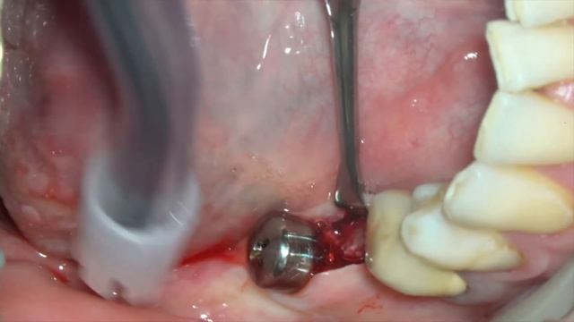 Установка формирователей десны на имплантаты Dentium в области зубов 4.6; 4.7. смотреть онлайн
