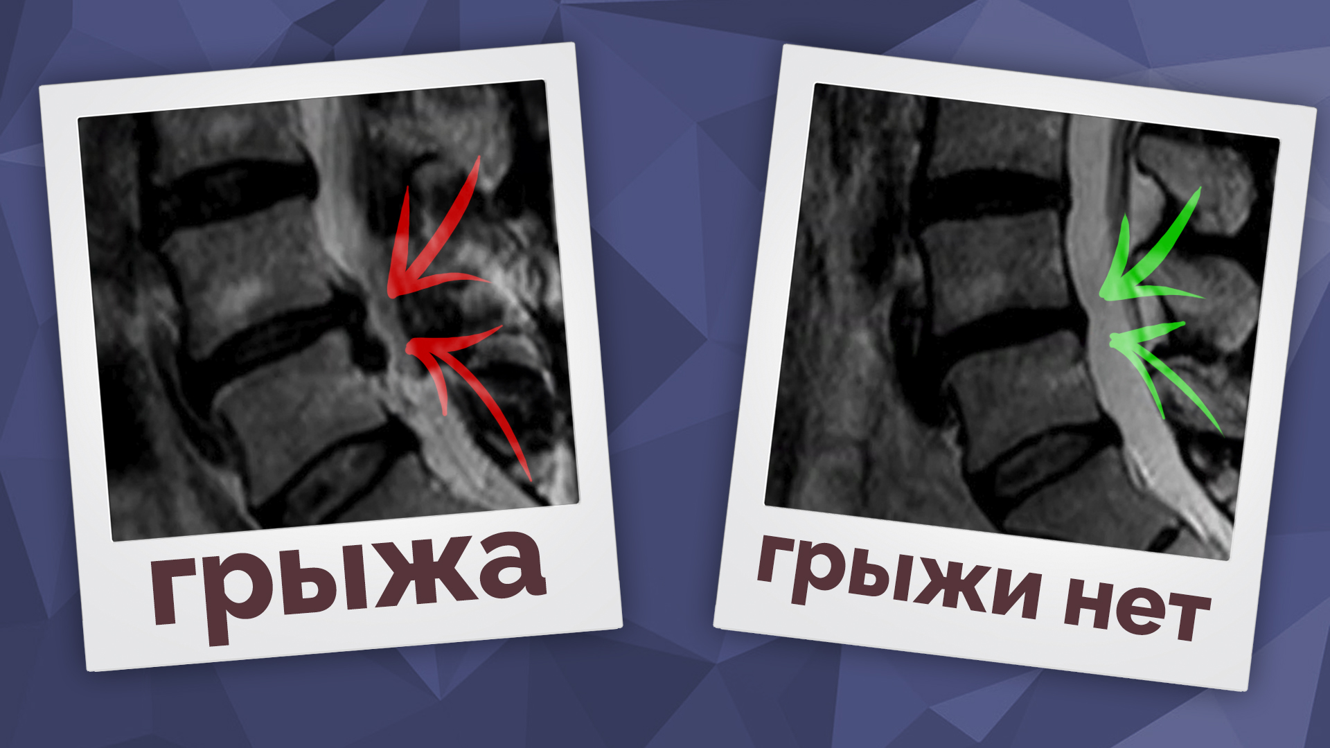 Избавление грыжи без операций - Реальный пациент! смотреть онлайн