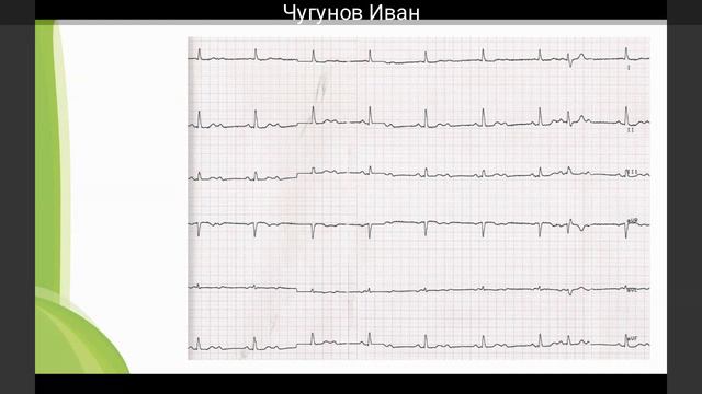 Электрокардиографическая диагностика нарушений проводимости сердца. Классификация нарушений проводим