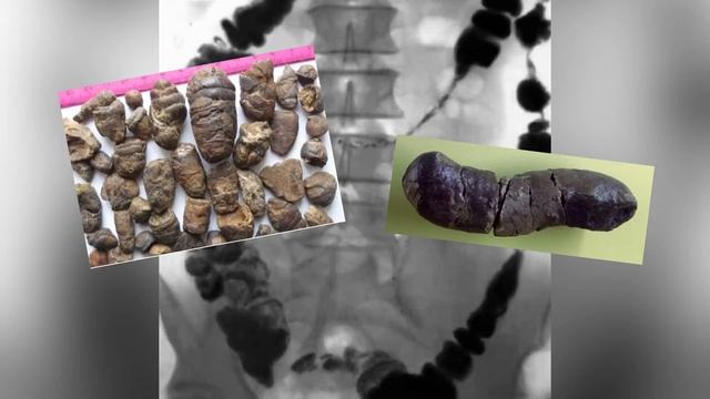 Рецепт дня. Как очистить кишечник после праздников. смотреть онлайн