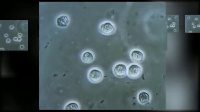 Things to be aware of regarding Low White Blood cell count? смотреть онлайн