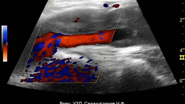 Пролонгированная аневризма подколенной артерии