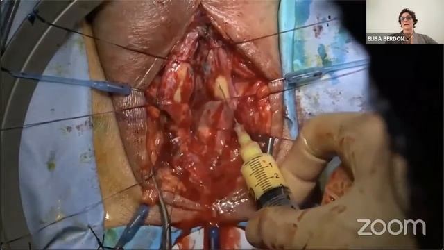 Urethroplasty with ultra-purified adipose tissue: the new concept of regenerative surgery смотреть онлайн