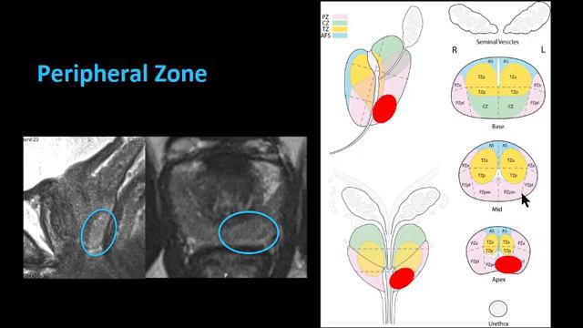 ISMRM MR Academy - Prostate MRI Image Interpretation смотреть онлайн