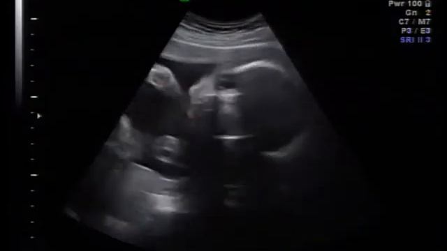 27 week 2D/3D/4D Ultrasound смотреть онлайн