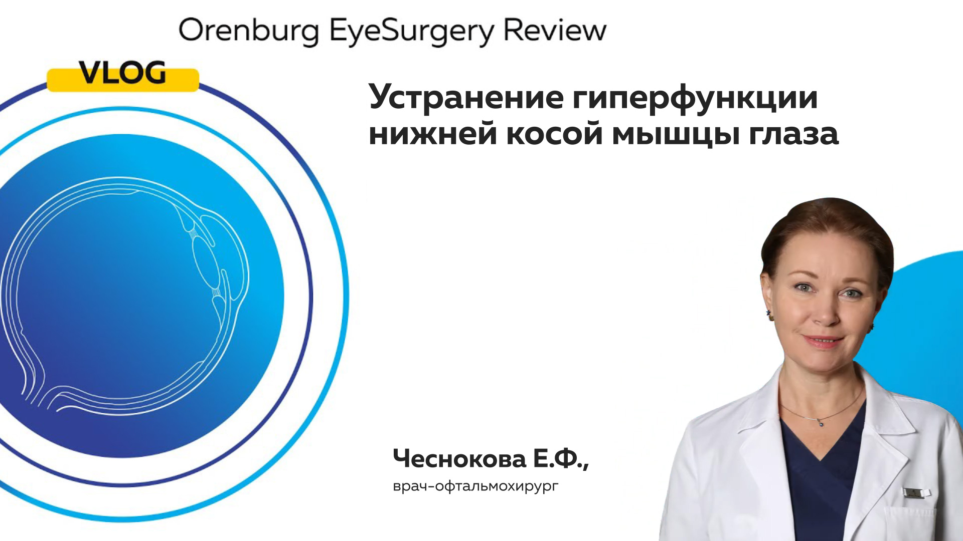 Устранение гиперфункции нижней косой мышцы глаза