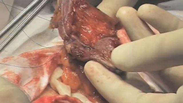 Десцендо-сигмоанастомоз смотреть онлайн