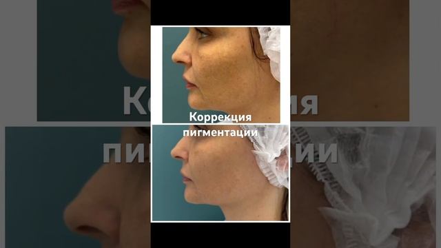 Пигментация на лице. смотреть онлайн