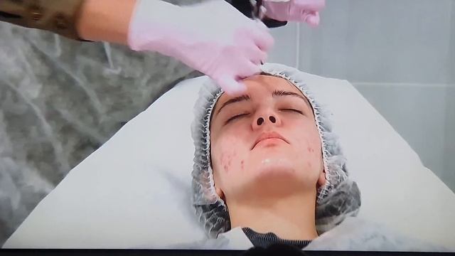 Пилинг Акне стоп Мелис смотреть онлайн
