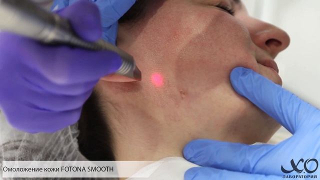 Лазерные методики в клинике ХО лаборатория. Аппарат Fotona. Часть 2 смотреть онлайн
