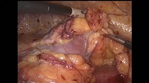 Laparoscopic Left Partial Nephrectomy / Лапароскопическая резекция левой почки