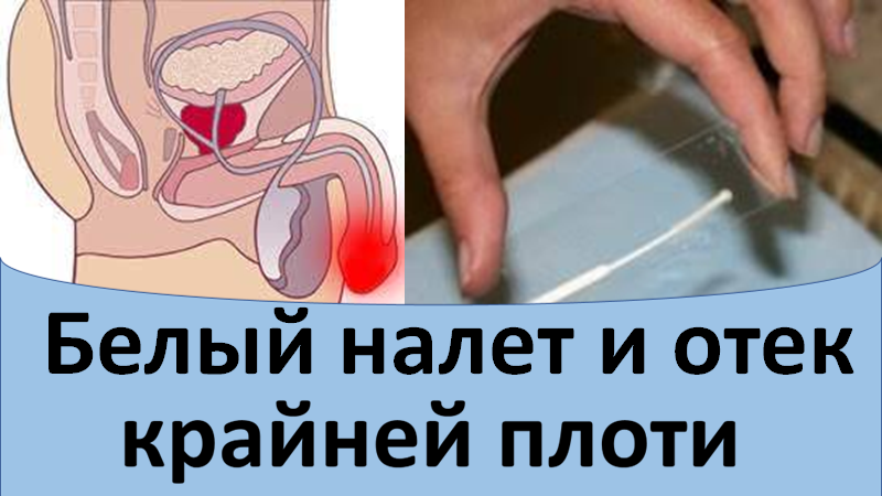 Белый налет и отек крайней плоти смотреть онлайн