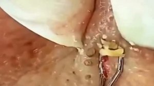 #21 УДАЛЕНИЕ КИСТОЗНЫХ ПРЫЩЕЙ! | УДАЛЕНИЕ УГРЕЙ!!