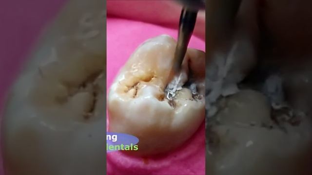 Broken tooth! смотреть онлайн