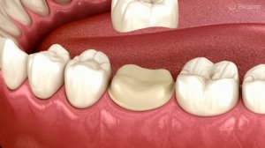 Установка коронки