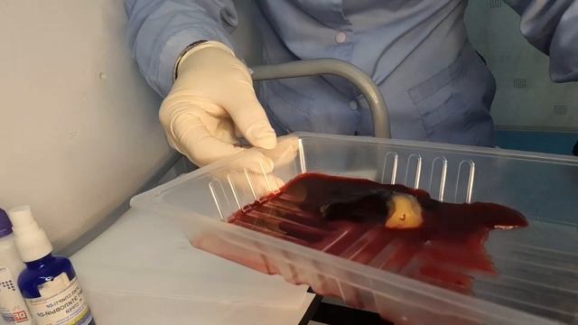 Венозное кровопускание ,проверка гематокрита на глаз ,и Холестерина Низкой плотности смотреть онлайн