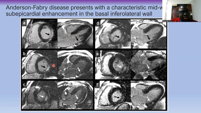 SWiM Observership | Myocardial Fibrosis | Dr Olukayode (Solomon) Aremu смотреть онлайн
