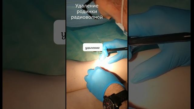 Удаление родинки радиоволной/Удаление родинок смотреть онлайн