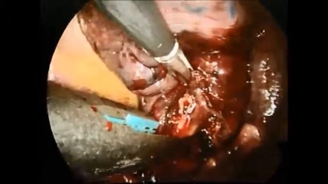 Uniportal VATS lobectomy(Lt. upper lobe) & mediastinal LN dissection смотреть онлайн