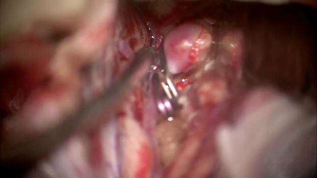 Клипирование аневризмы перикаллезной артерии справа / Pericallosal aneurysm смотреть онлайн