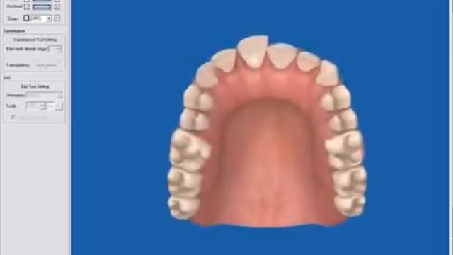 Step-by-step guide to Invisalign and how it works смотреть онлайн