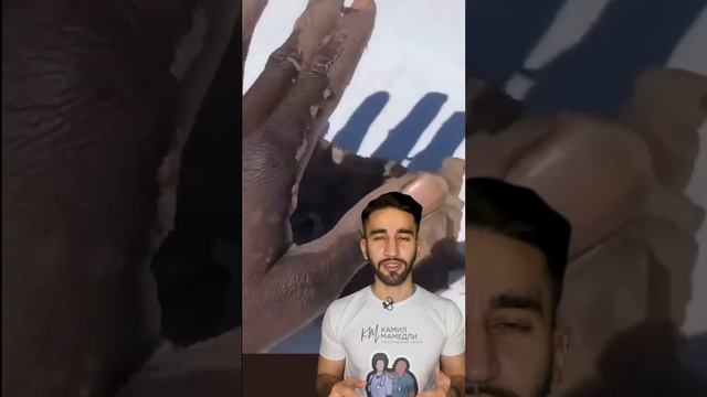 кожа ладони смотреть онлайн