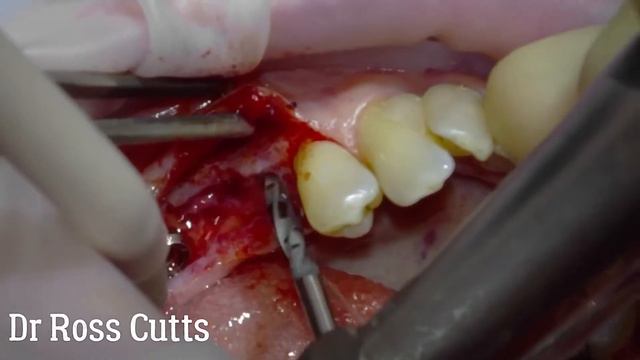 Dental Implant Placement