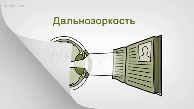 Миопия, гиперметропия, астигматизм смотреть онлайн