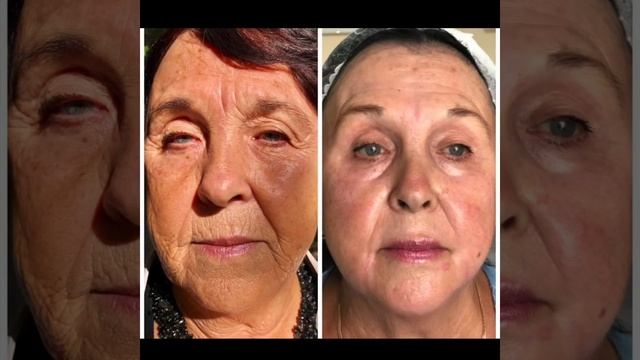 Шлифовка лица лазером смотреть онлайн