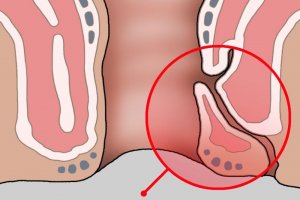 Свищ прямой кишки. Хирург-проктолог Марьяна Абрицова