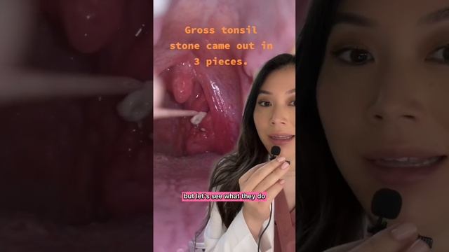 SKILLFULLY removing huge juicy Tonsil Stones with a Sharp wooden pick! #tonsilstones смотреть онлайн