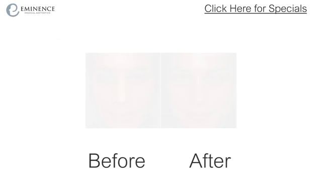 Chemical Peel Before & After Photos Incredible Results in Princeton New Jersey смотреть онлайн