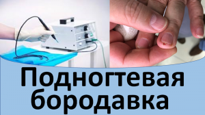 Подногтевая бородавка.